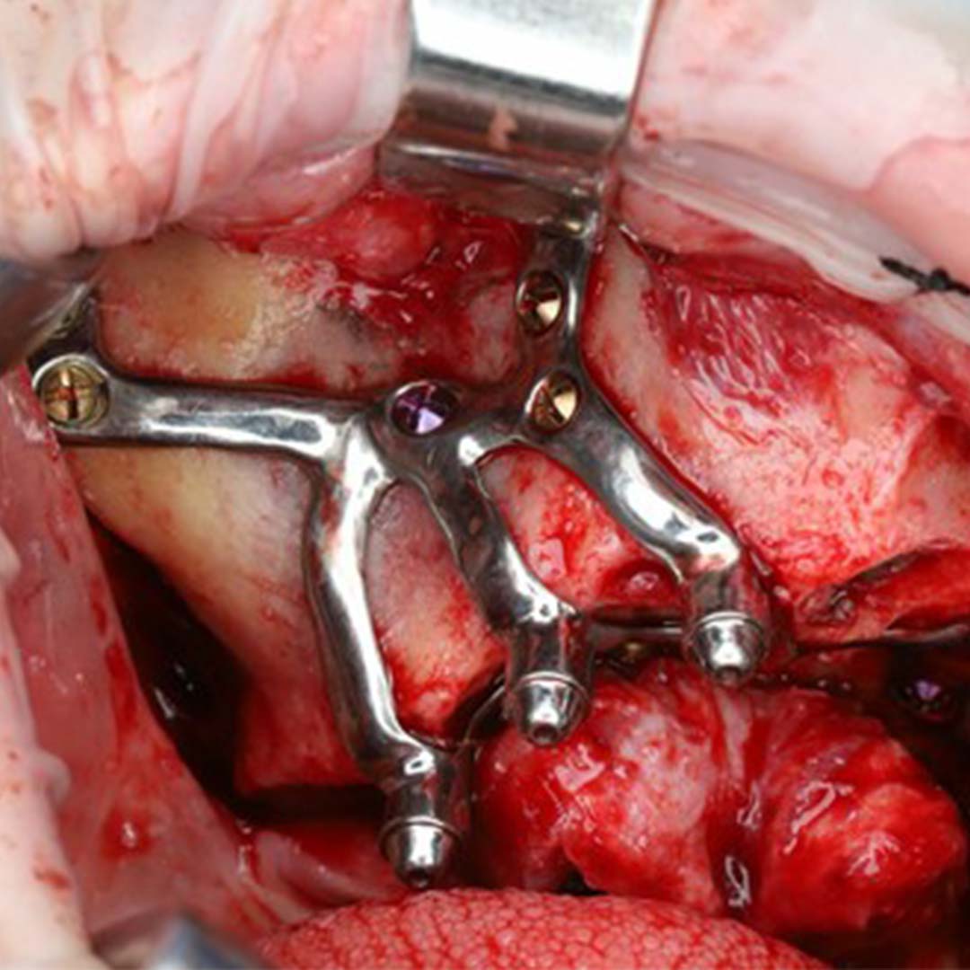 Caso clínico implantes subperiósticos_0000_big-6