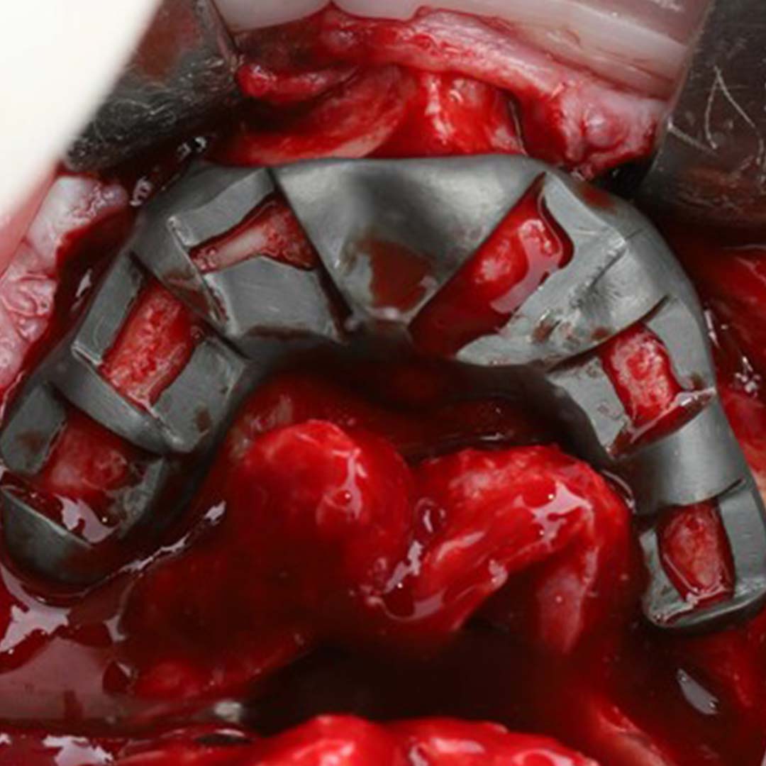 Caso clínico implantes subperiósticos_0001_big-3 implantes subperiósticos de Fresmedical.