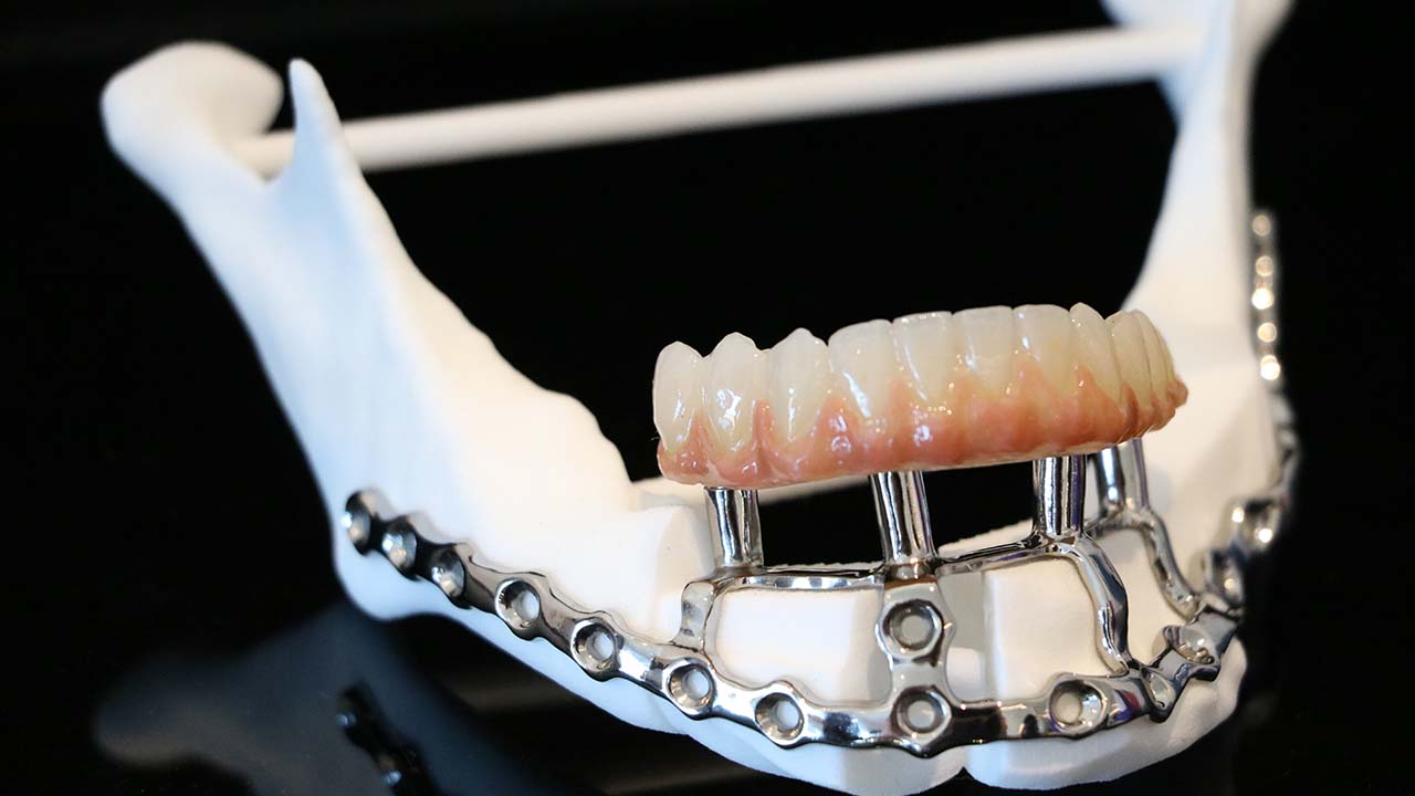 el implante subperióstico de Fresmedical2 implantes subperiósticos de Fresmedical.