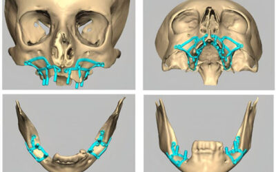 Protegido: De lo artesanal a lo digital en implantología subperióstica