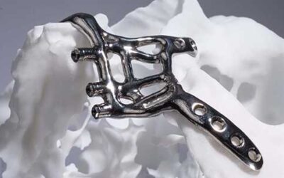 Protegido: Implantes subperiósticos fabricados con precisión digital