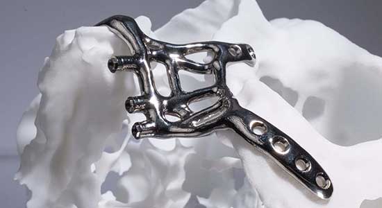 Protegido: Implantes subperiósticos fabricados con precisión digital