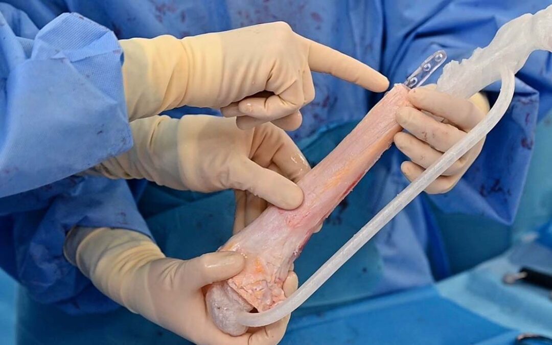 Implantes médicos a medida en cirugía oncológica pediátrica