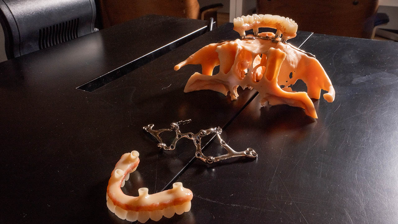 implantes subperiósticos de Fresmedical.